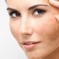 Melasma
